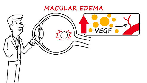 Macular Edema